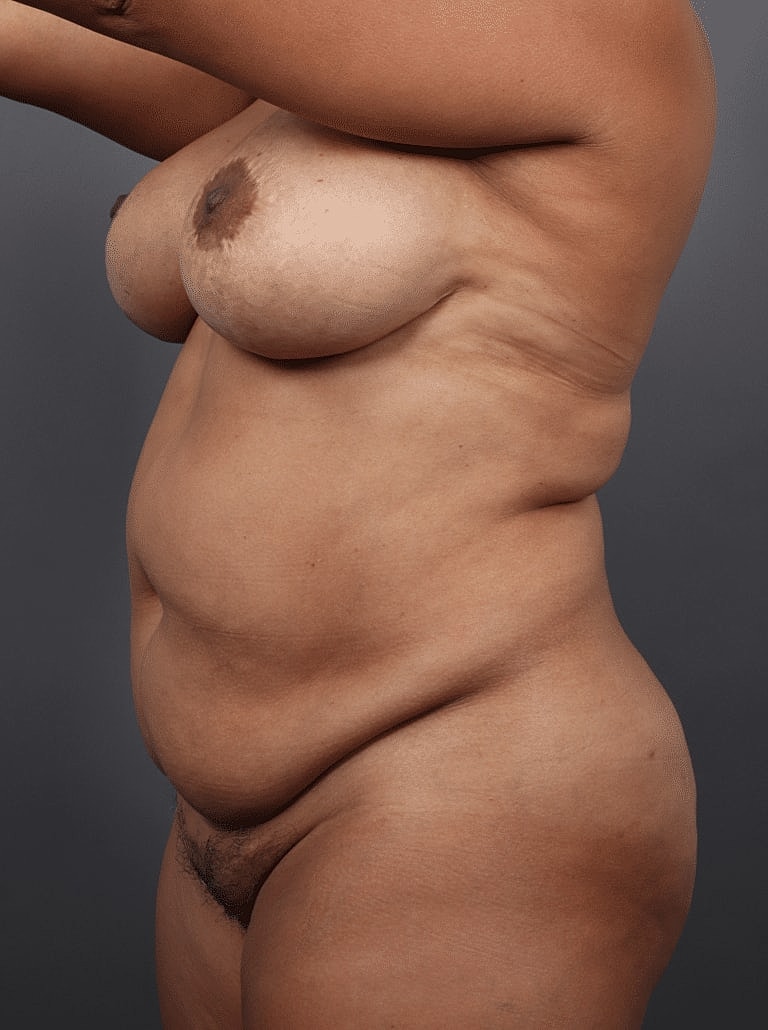 Liposuction Before & After