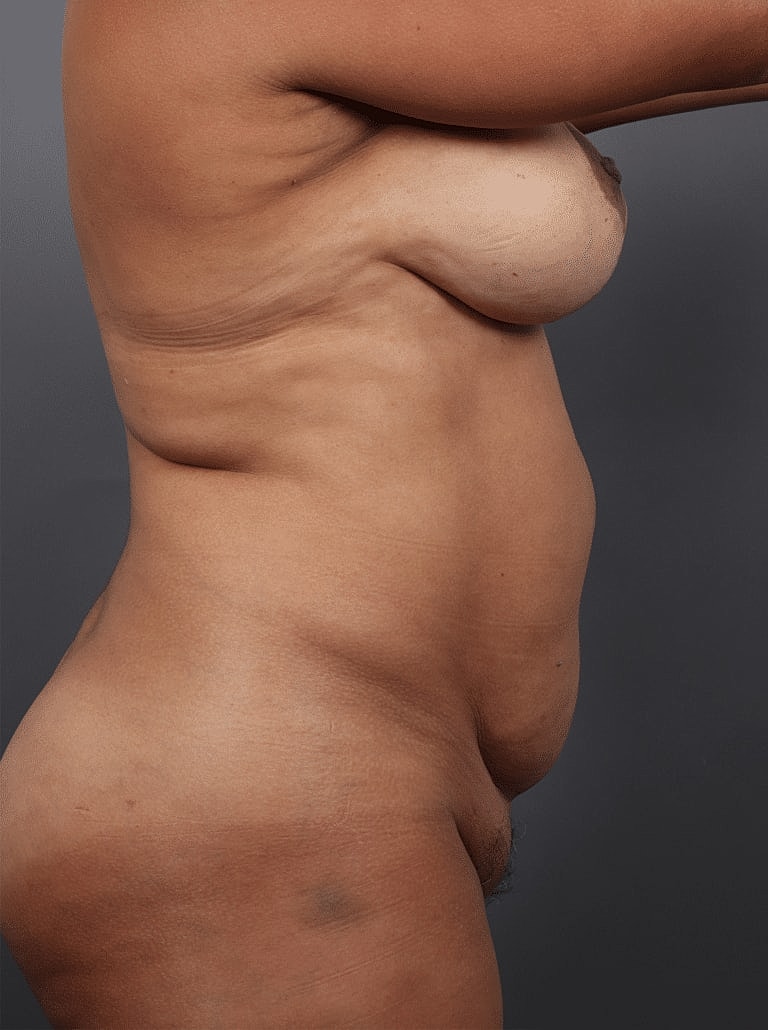 Liposuction Before & After