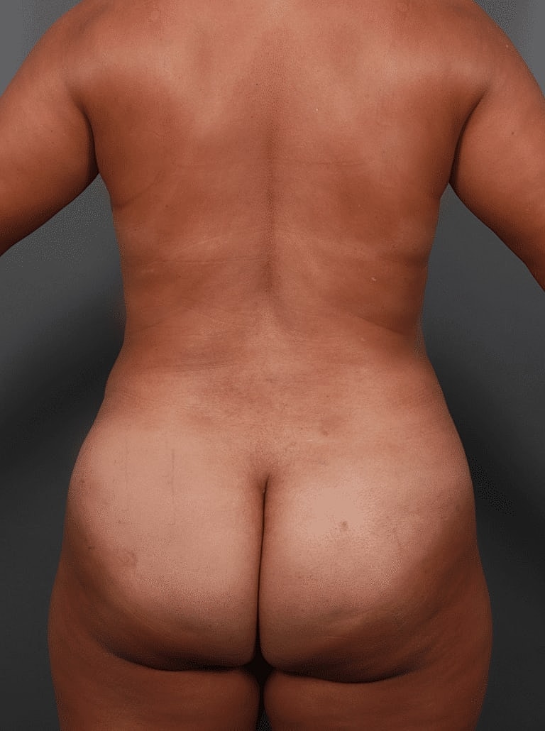 Liposuction Before & After