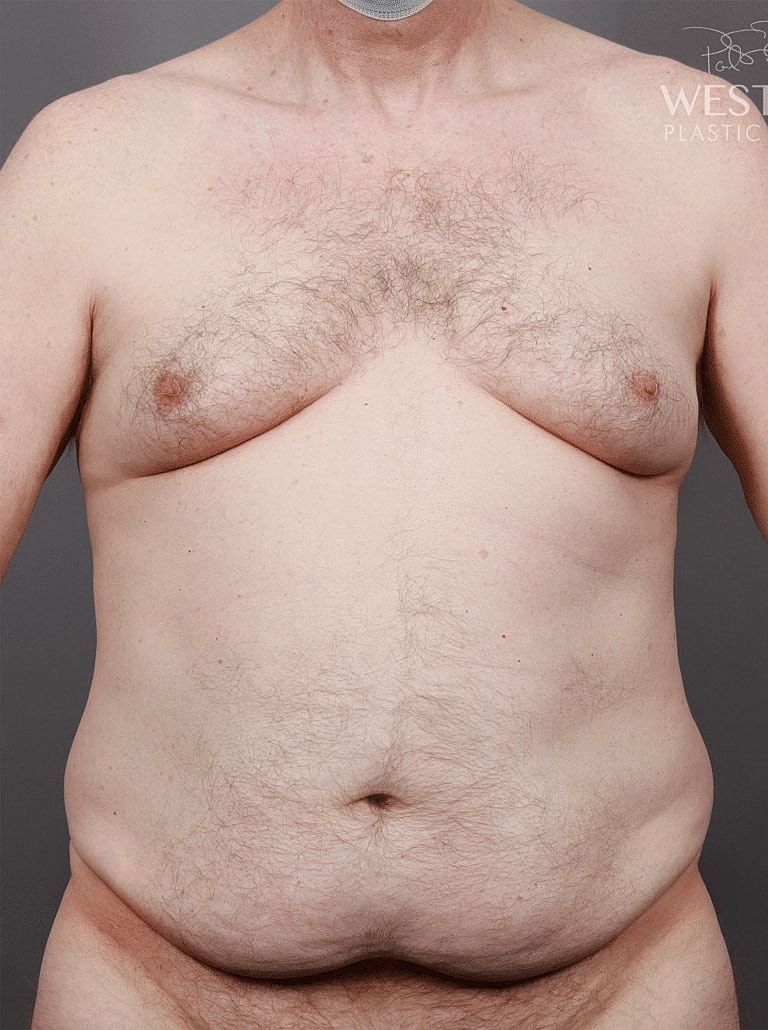 Liposuction Before & After