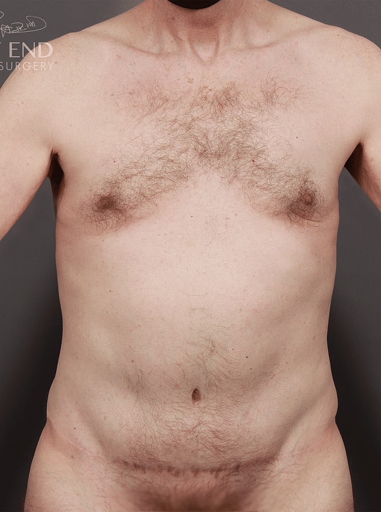 Liposuction Before & After