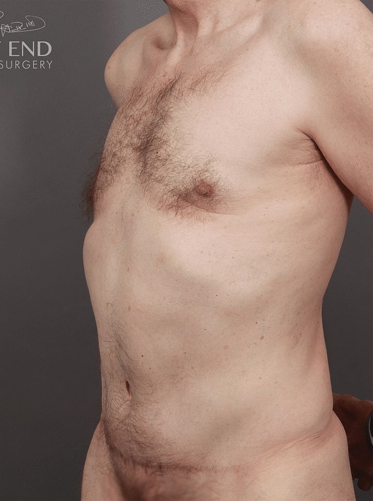 Liposuction Before & After