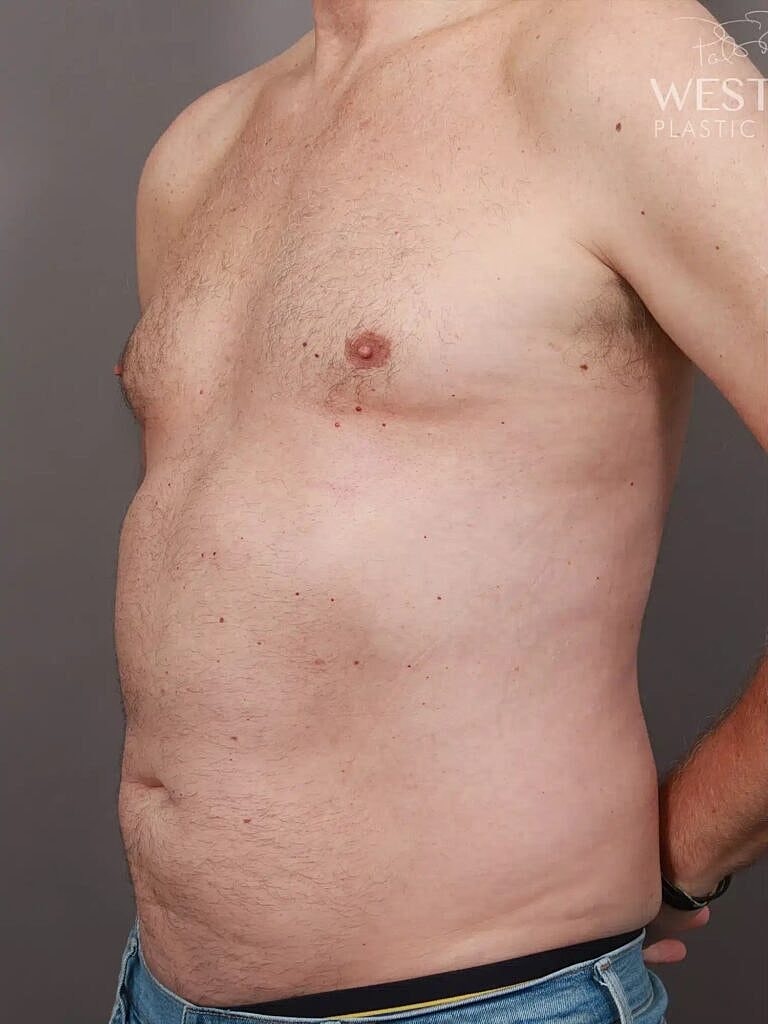 Liposuction Before & After