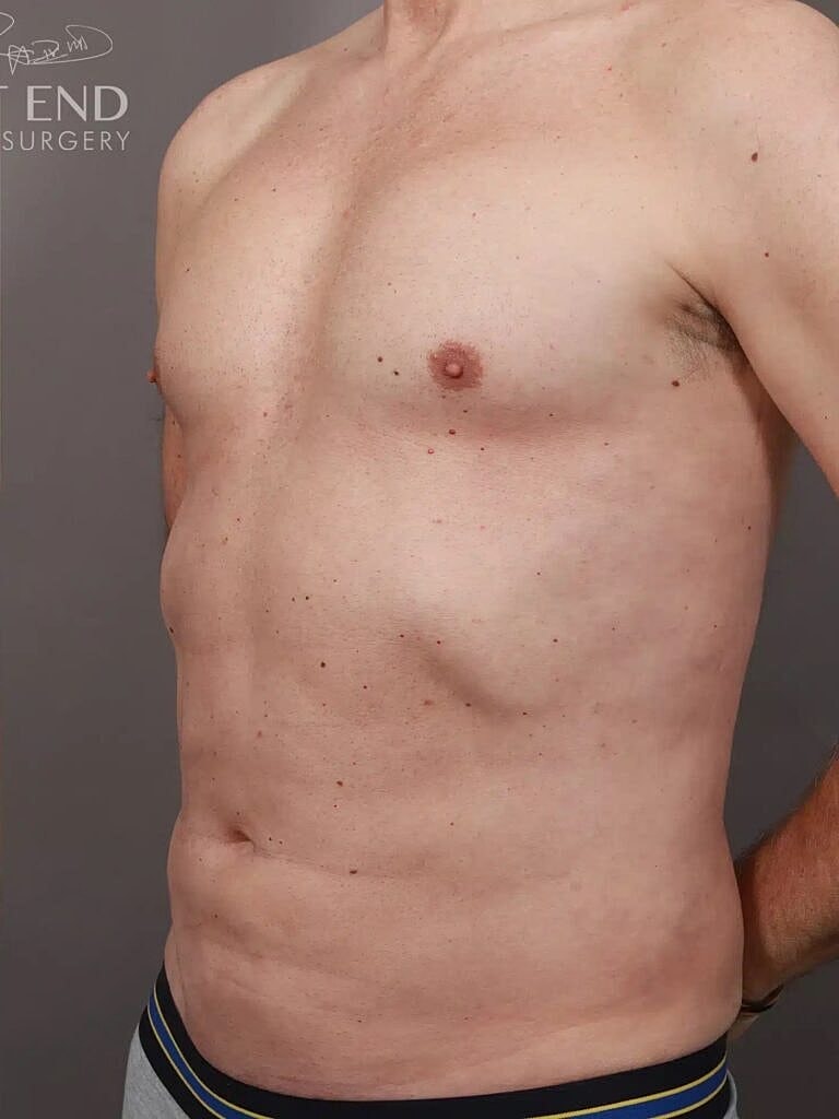Liposuction Before & After