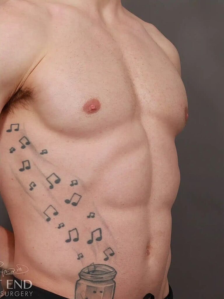 Liposuction Before & After
