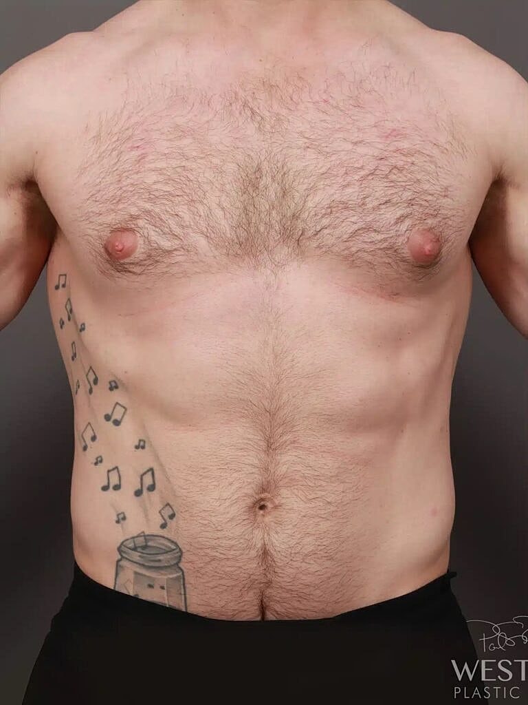 Liposuction Before & After
