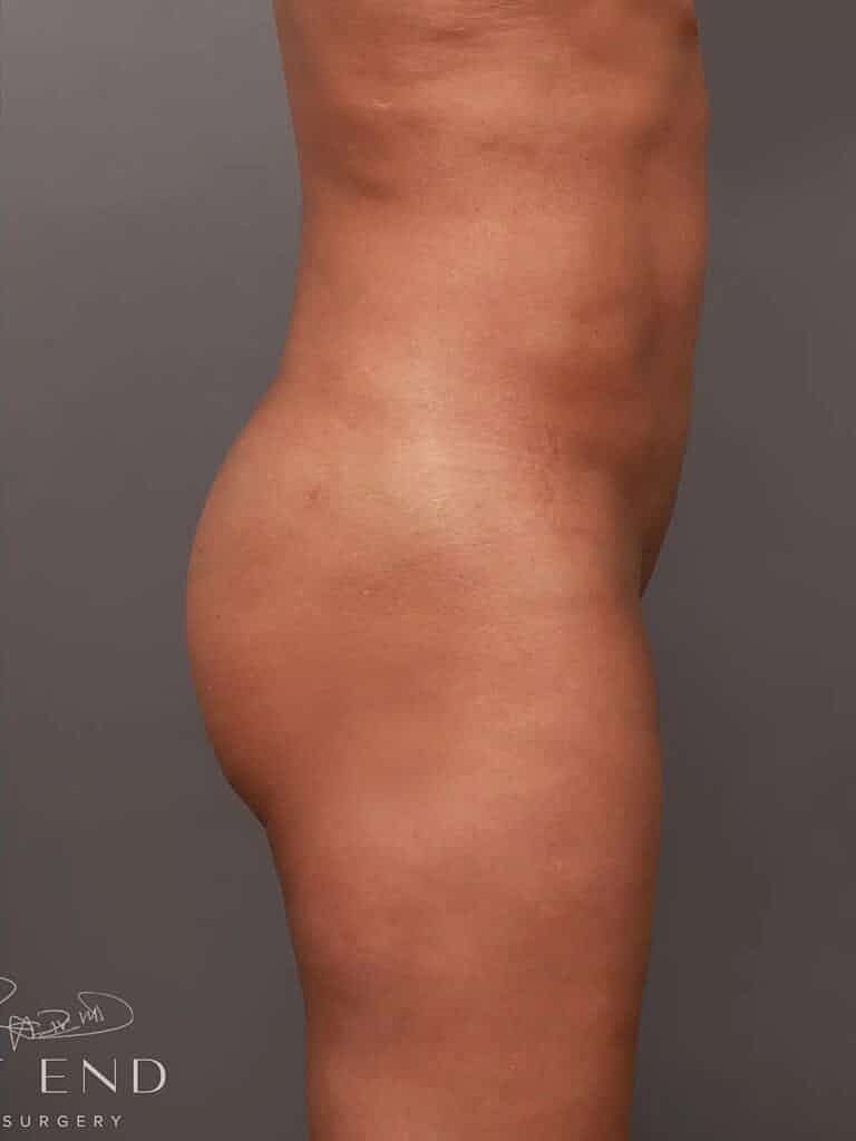 Liposuction Before & After