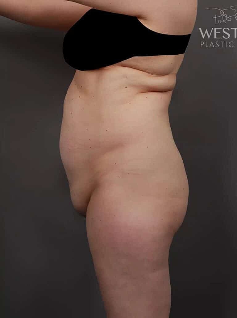 Liposuction Before & After