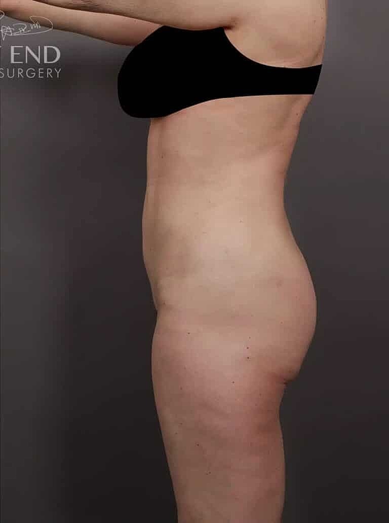 Liposuction Before & After