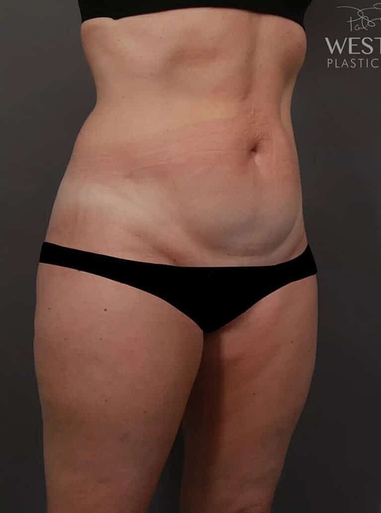 Liposuction Before & After