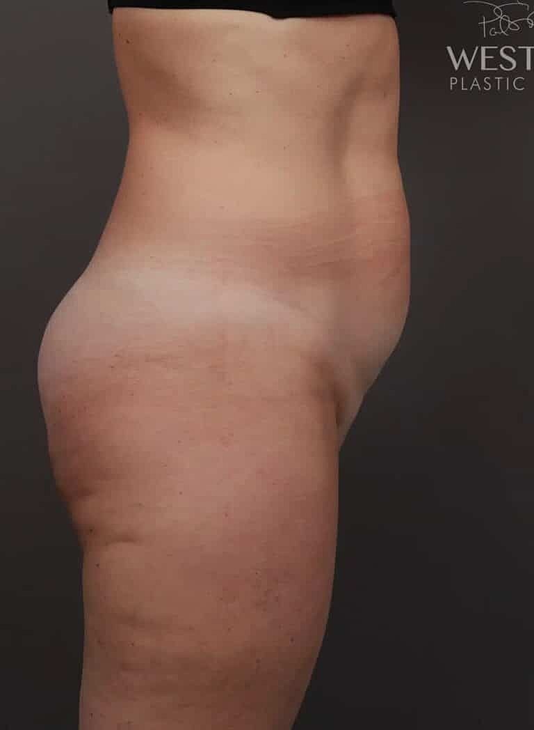 Liposuction Before & After