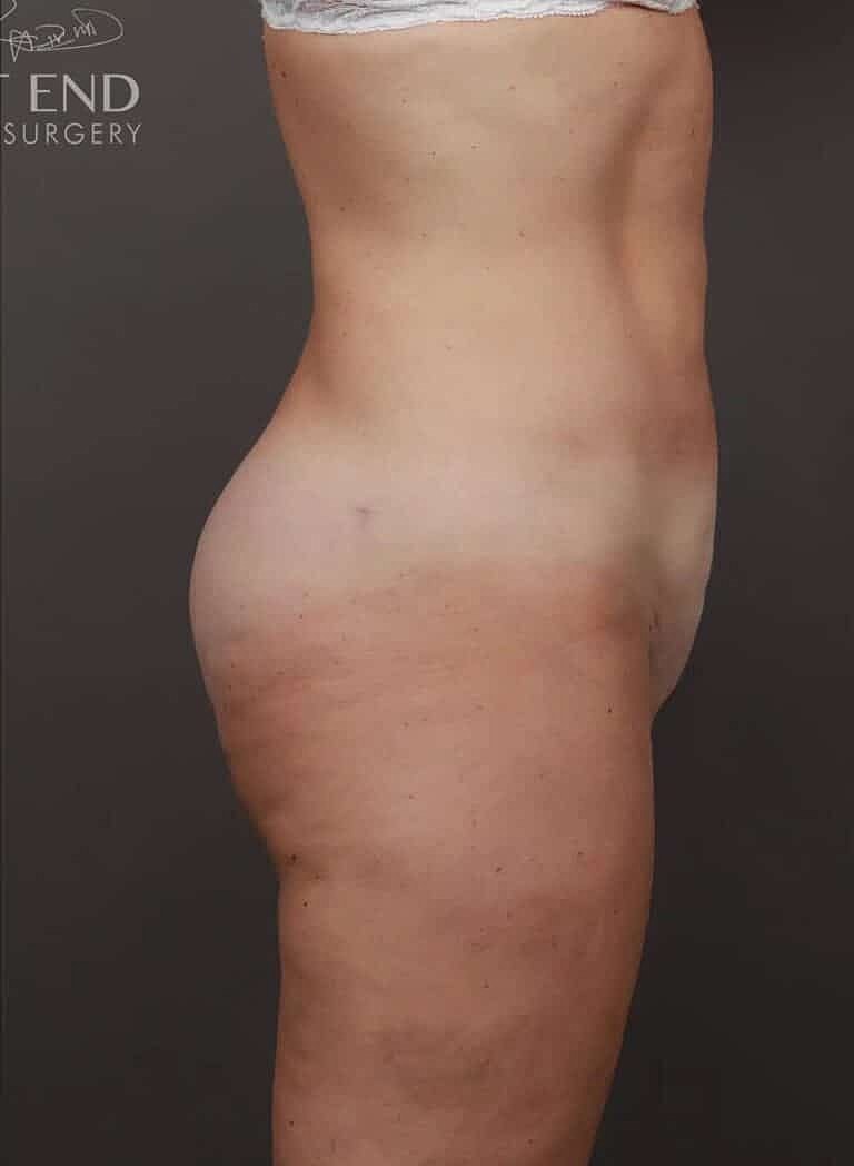Liposuction Before & After