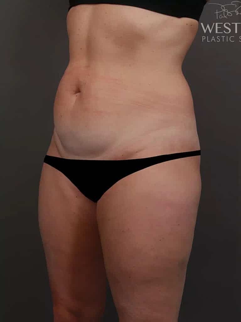 Liposuction Before & After
