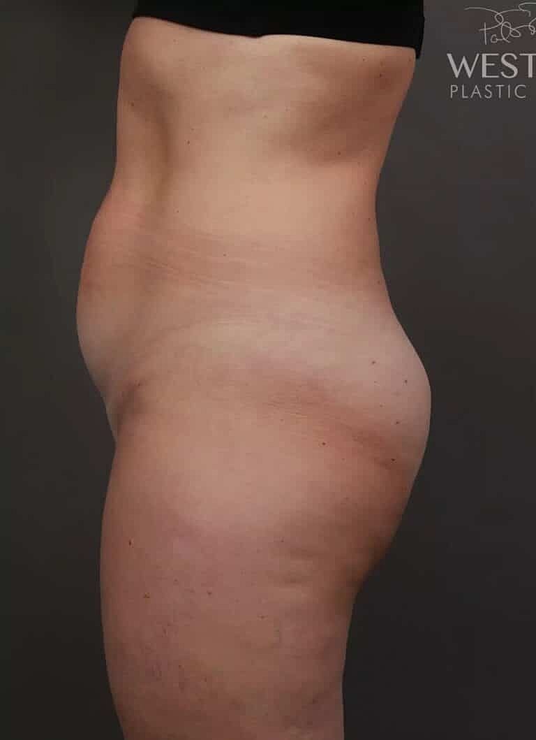 Liposuction Before & After