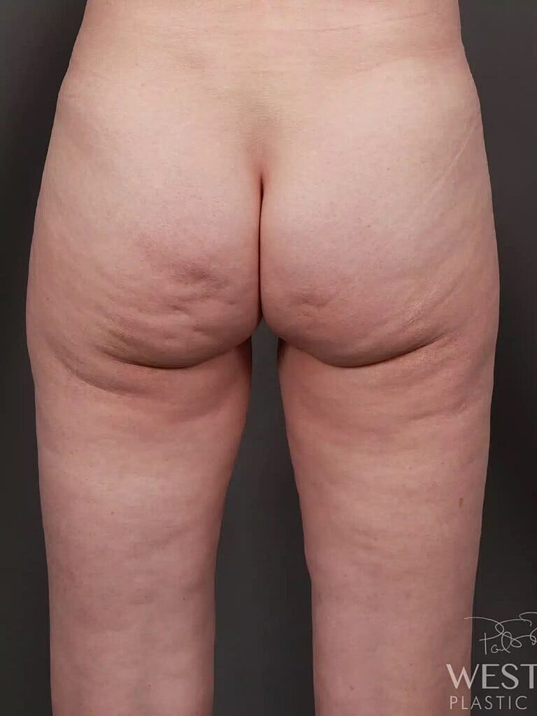 Liposuction Before & After