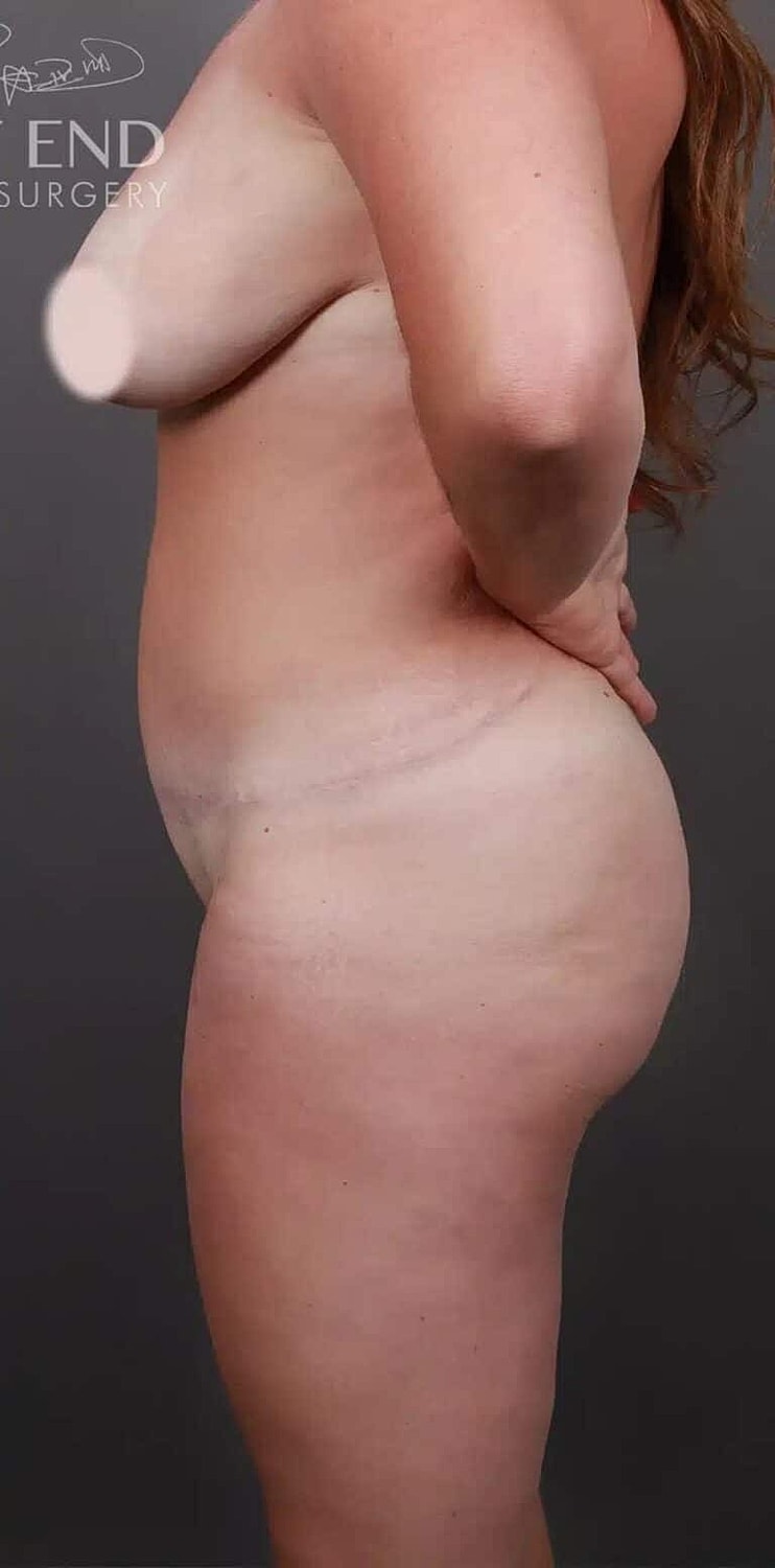 Liposuction Before & After