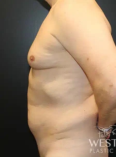 Liposuction Before & After