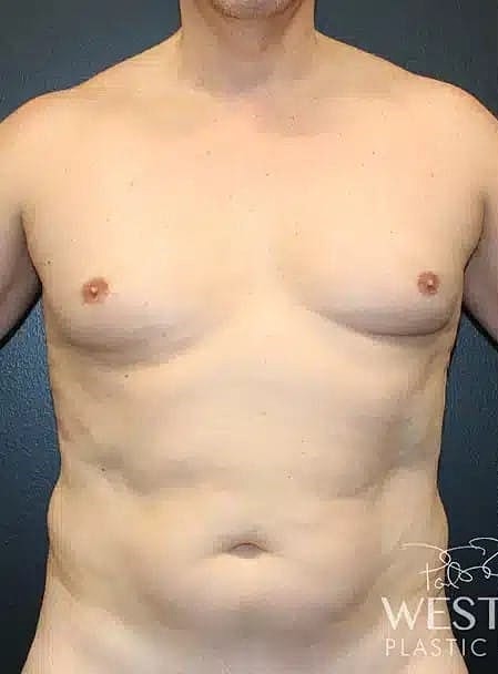 Liposuction Before & After