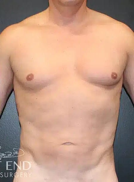 Liposuction Before & After
