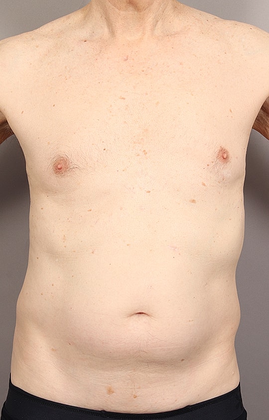 Liposuction Before & After