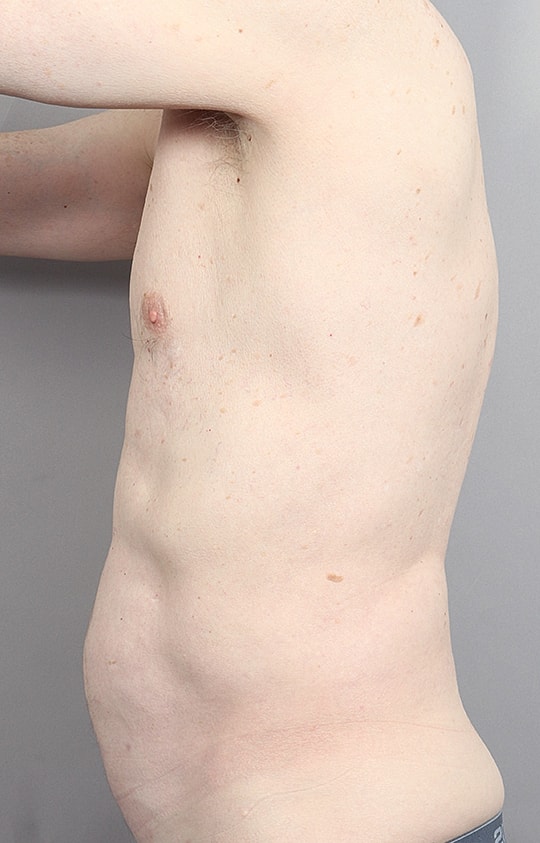 Liposuction Before & After