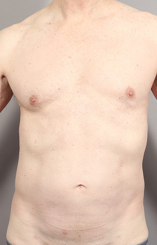 Liposuction Before & After