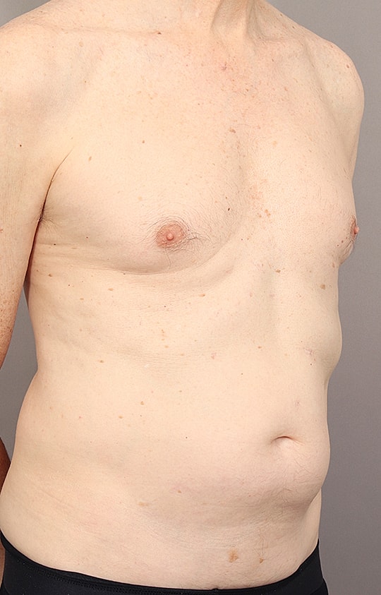 Liposuction Before & After