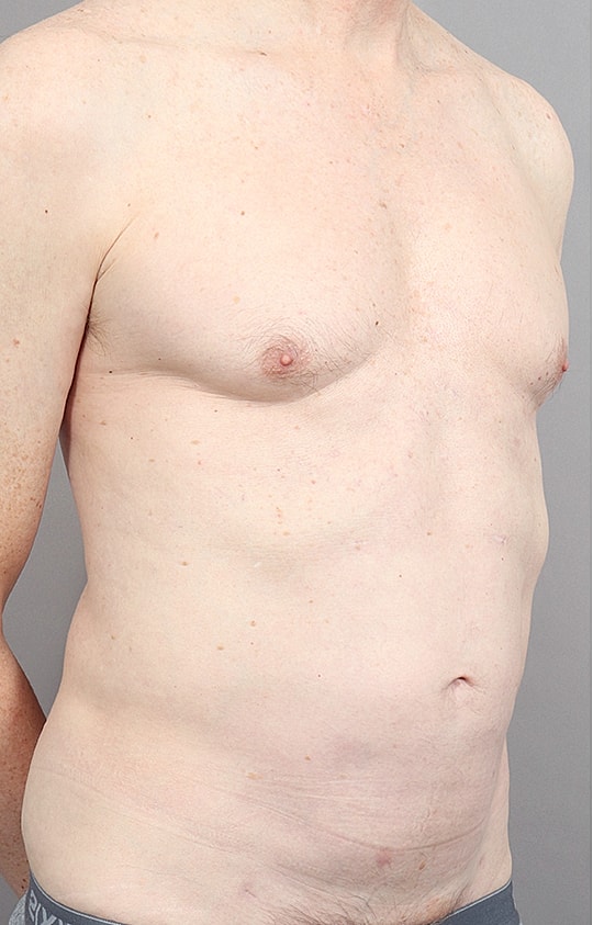 Liposuction Before & After