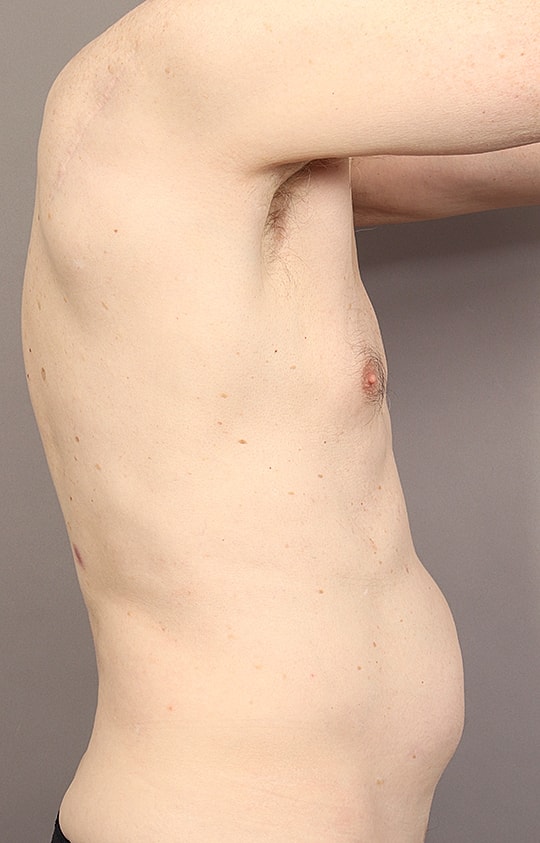Liposuction Before & After