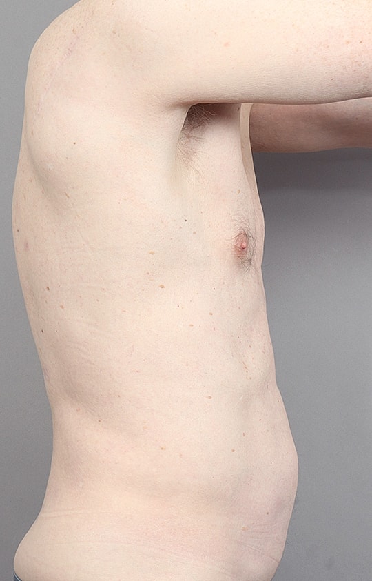 Liposuction Before & After