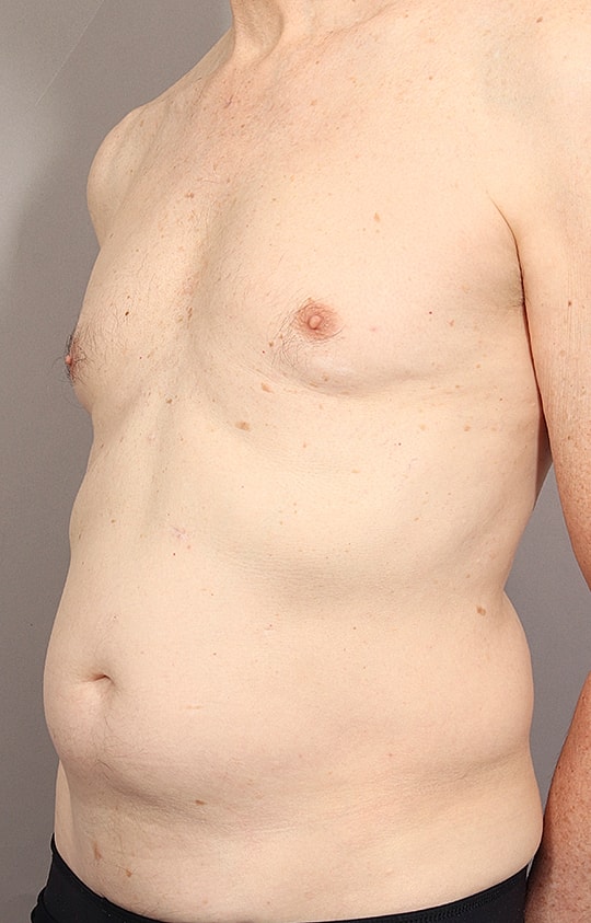 Liposuction Before & After