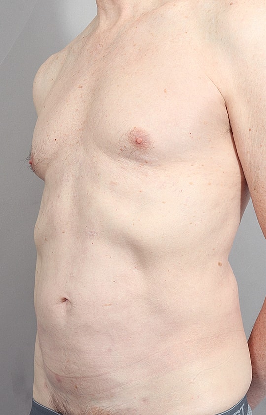 Liposuction Before & After