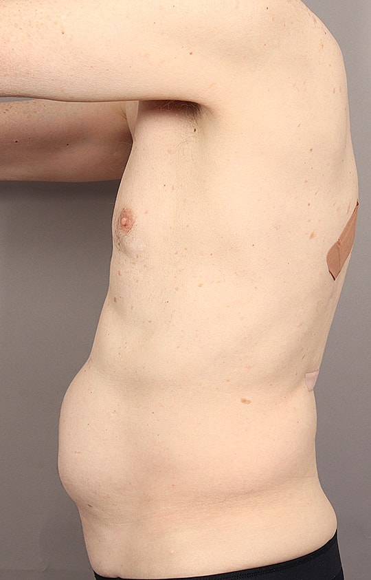 Liposuction Before & After