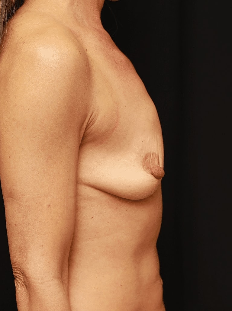 Breast Lift Before & After