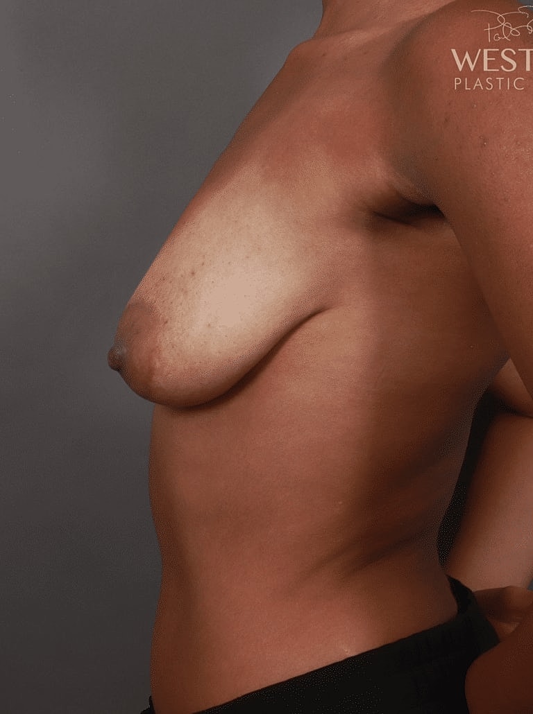 Breast Lift Before & After