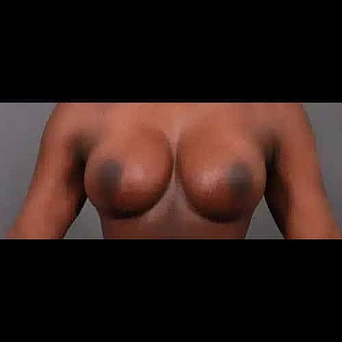 Breast Lift Before & After