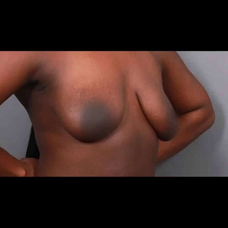 Breast Lift Before & After