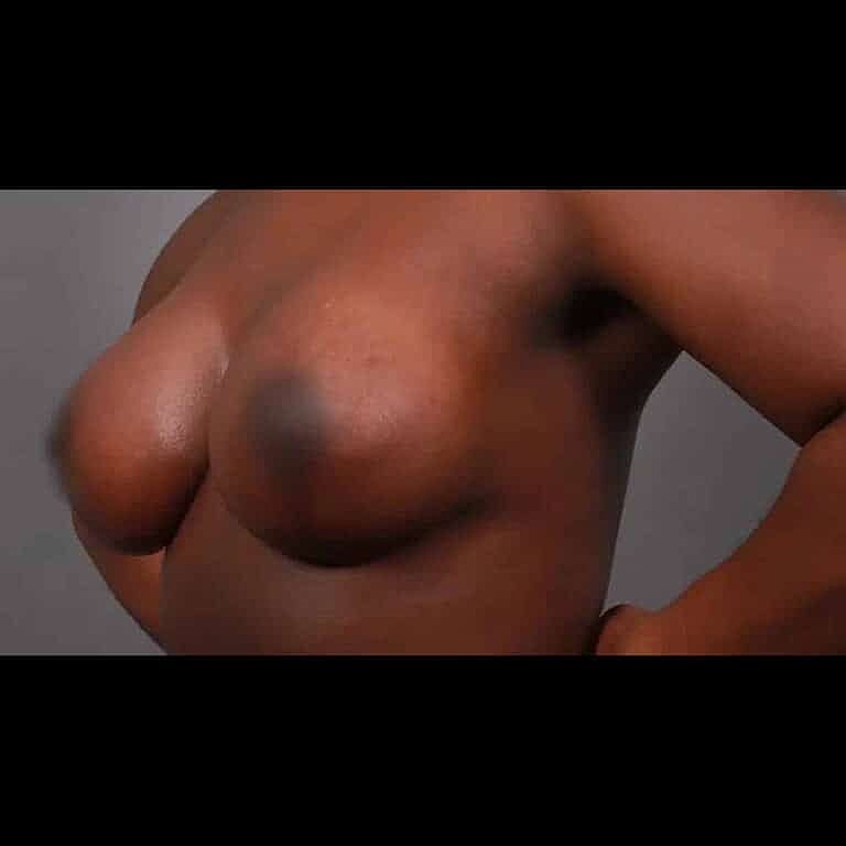 Breast Lift Before & After