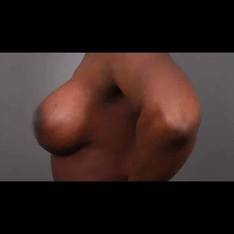 Breast Lift Before & After