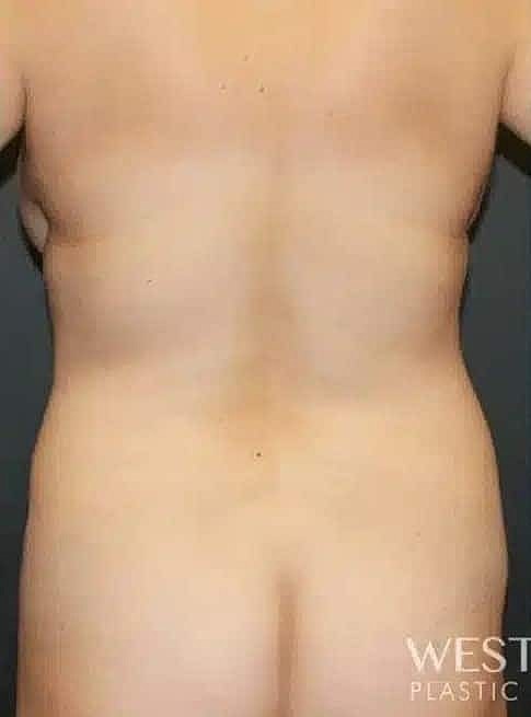 Breast Lift Before & After