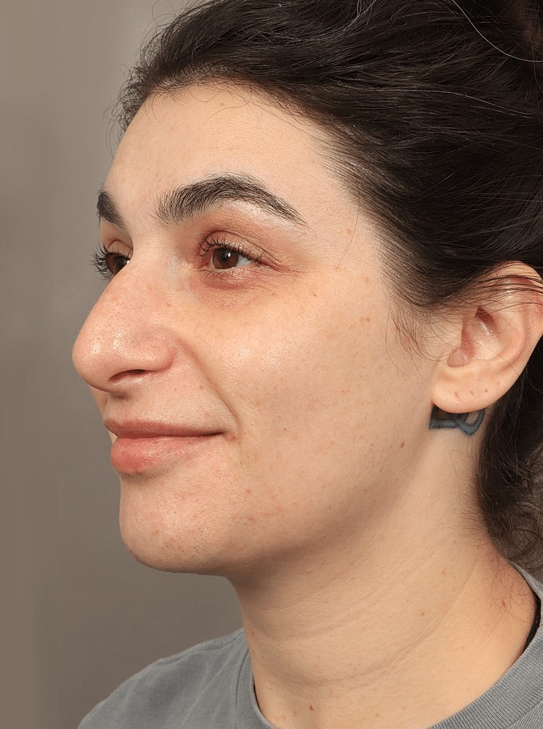 Restylane Before & After