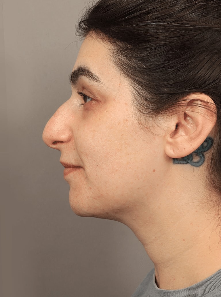 Restylane Before & After