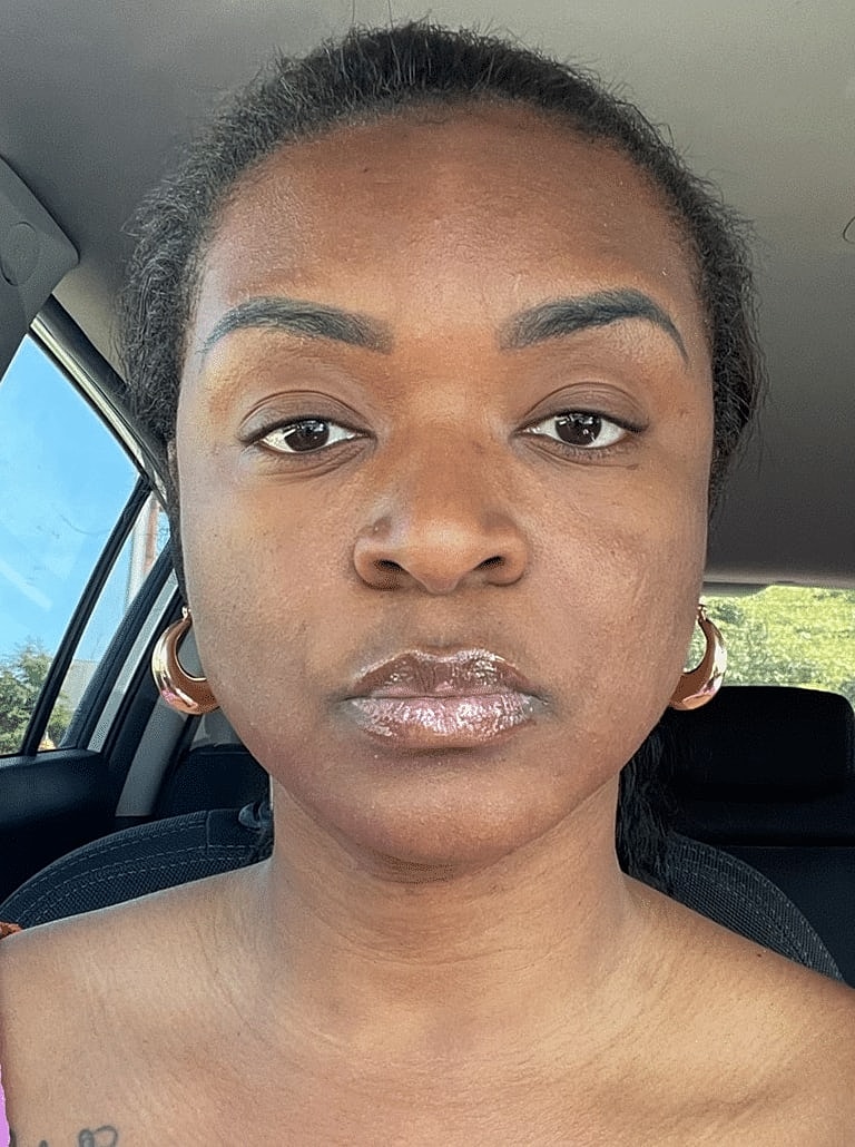 Restylane Before & After