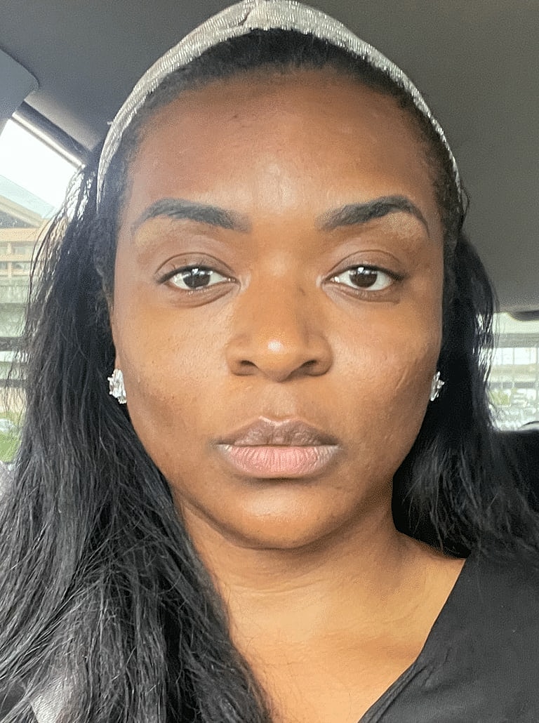 Restylane Before & After