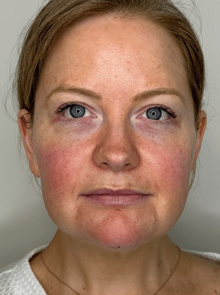 Restylane Before & After