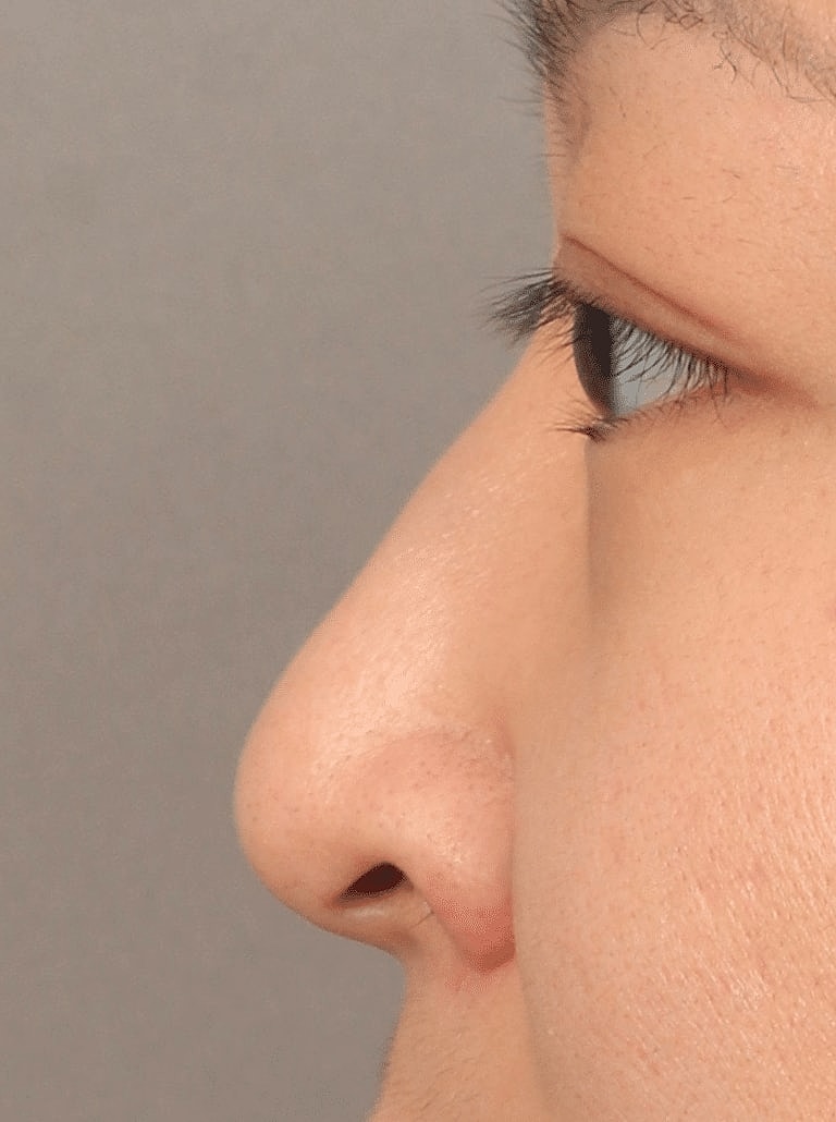 Restylane Before & After