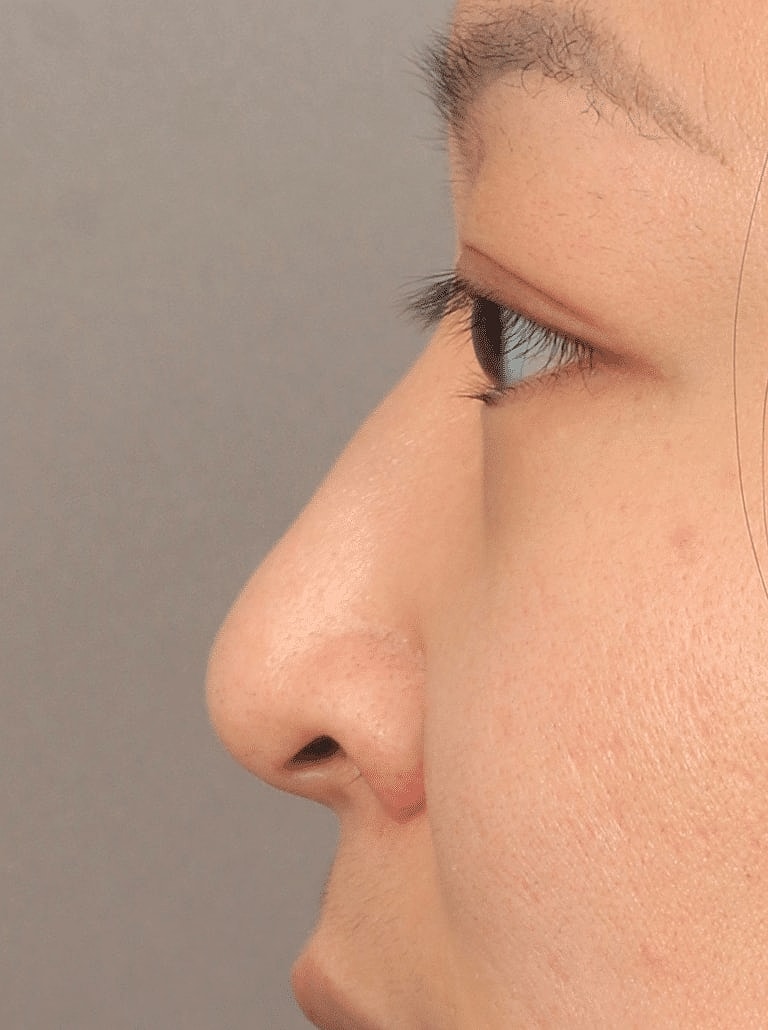 Restylane Before & After