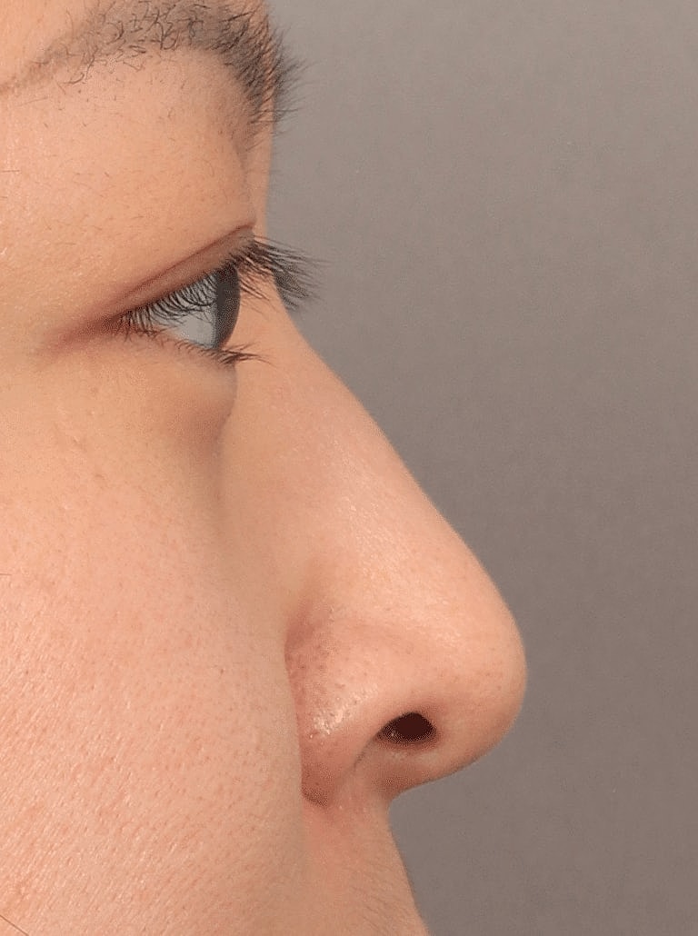 Restylane Before & After