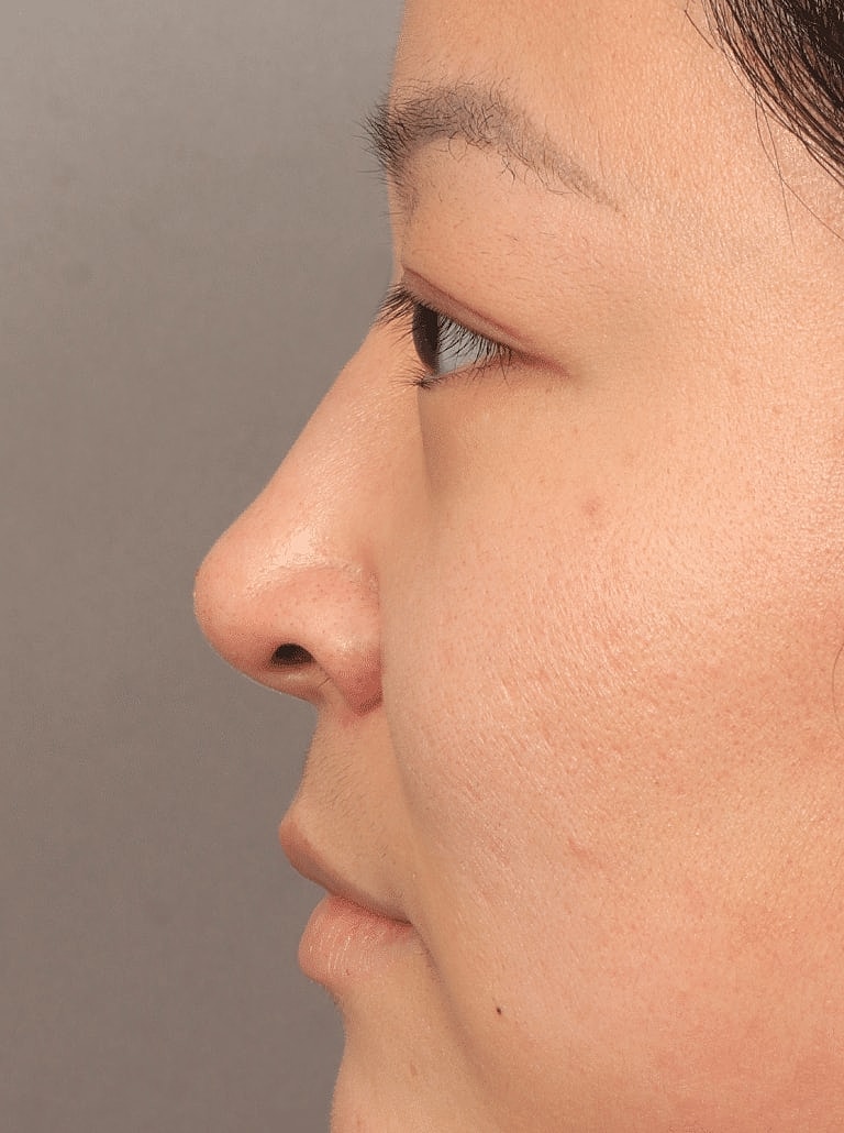 Restylane Before & After