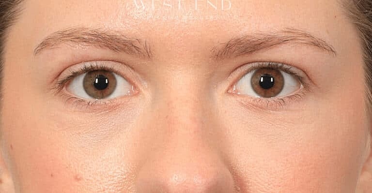 Restylane Before & After